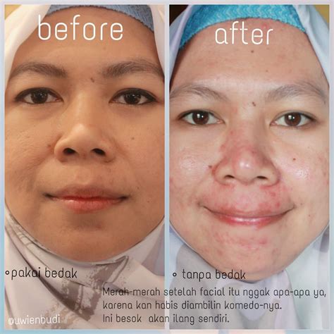 7 Biaya Perawatan di Erha yang Perlu Diketahui Sebelum Melakukan Perawatan Kulit!
