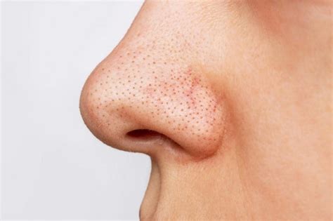 7 Cara Ampuh Treatment Menghilangkan Komedo dalam 1 Minggu! 7 Cara Ampuh Treatment Menghilangkan Komedo dalam 1 Minggu!