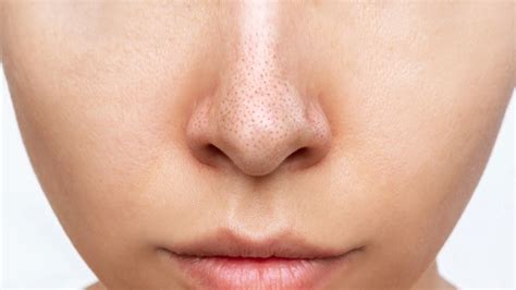 7 Cara Ampuh Treatment Menghilangkan Komedo dalam 1 Minggu! 7 Cara Ampuh Treatment Menghilangkan Komedo dalam 1 Minggu!