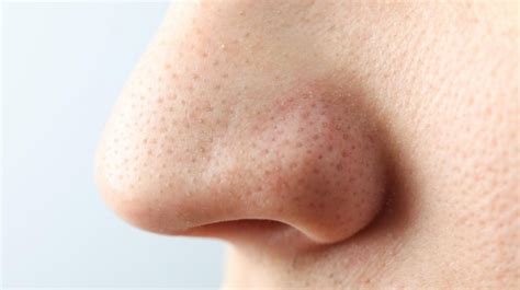 7 Cara Ampuh Treatment Menghilangkan Komedo dalam 1 Minggu! 7 Cara Ampuh Treatment Menghilangkan Komedo dalam 1 Minggu!