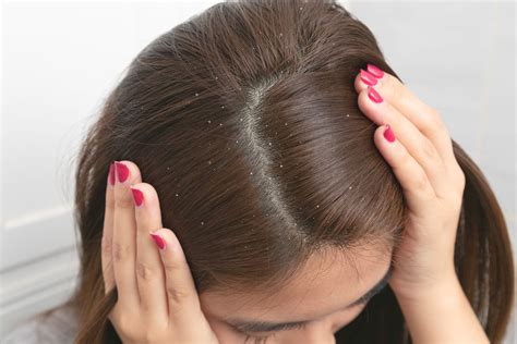 7 Cara Merawat Kulit Kepala Kering yang Ampuh dalam 30 Hari