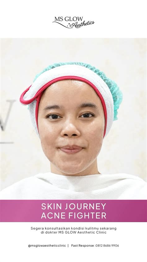 5 Alasan Harga Treatment Scarlett Worth Banget: Mulai dari RpXXX! 5 Alasan Harga Treatment Scarlett Worth Banget: Mulai dari RpXXX!
