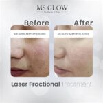 5 Fakta Harga Treatment Wajah MS Glow: Ada yang di Bawah 100 Ribu!