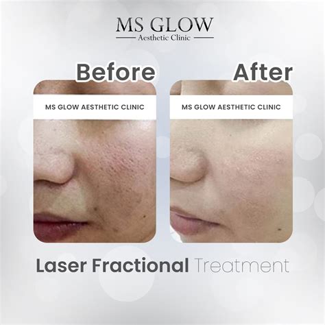 5 Fakta Harga Treatment Wajah MS Glow: Ada yang di Bawah 100 Ribu!