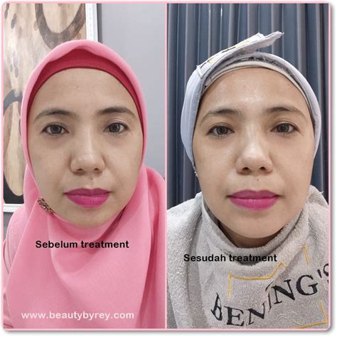 5 Treatment Wajah Benings Clinic: Harga Mulai 99 Ribu! 5 Treatment Wajah Benings Clinic: Harga Mulai 99 Ribu!