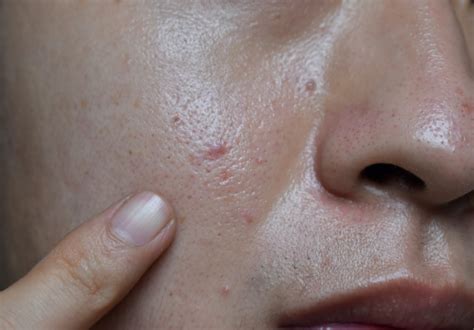 7 Langkah Bye-Bye Jerawat: Kulit Mulus Auto Glowing! 7 Langkah Bye-Bye Jerawat: Kulit Mulus Auto Glowing!