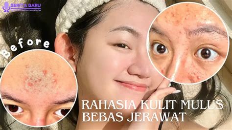 7 Langkah Bye-Bye Jerawat: Kulit Mulus Auto Glowing! 7 Langkah Bye-Bye Jerawat: Kulit Mulus Auto Glowing!
