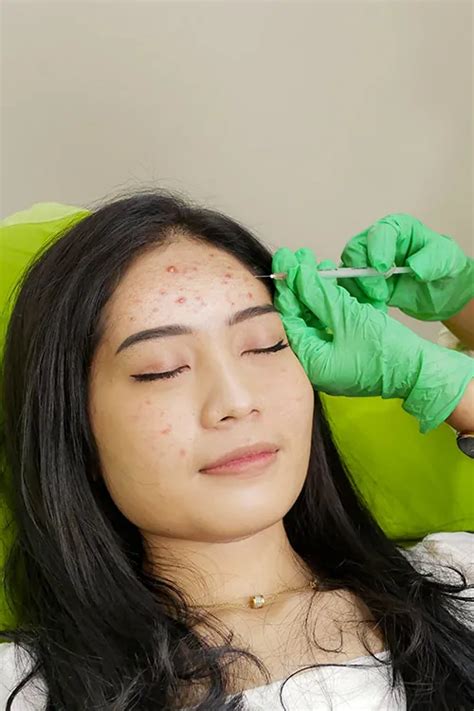 5 Rahasia Ampuh Hilangkan Jerawat Punggung di ZAP: Hasilnya dalam Hitungan Hari! 5 Rahasia Ampuh Hilangkan Jerawat Punggung di ZAP: Hasilnya dalam Hitungan Hari!