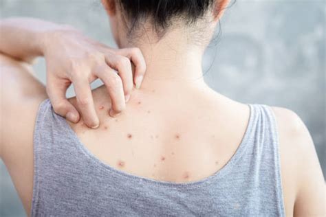 5 Rahasia Ampuh Hilangkan Jerawat Punggung di ZAP: Hasilnya dalam Hitungan Hari! 5 Rahasia Ampuh Hilangkan Jerawat Punggung di ZAP: Hasilnya dalam Hitungan Hari!