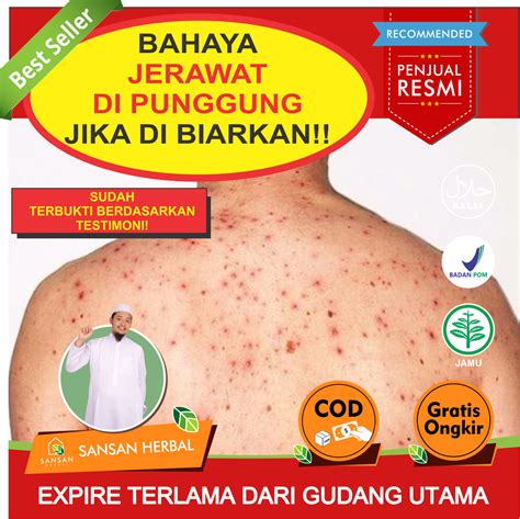 5 Rahasia Ampuh Hilangkan Jerawat Punggung di ZAP: Hasilnya dalam Hitungan Hari! 5 Rahasia Ampuh Hilangkan Jerawat Punggung di ZAP: Hasilnya dalam Hitungan Hari!